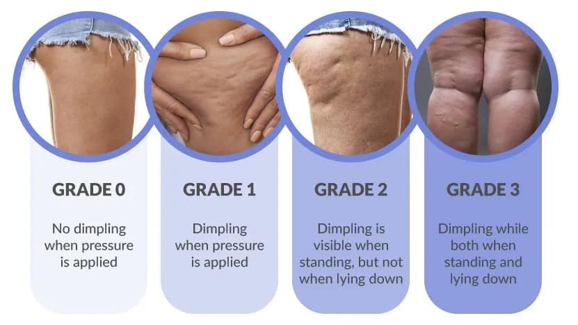 Get rid of cellulite