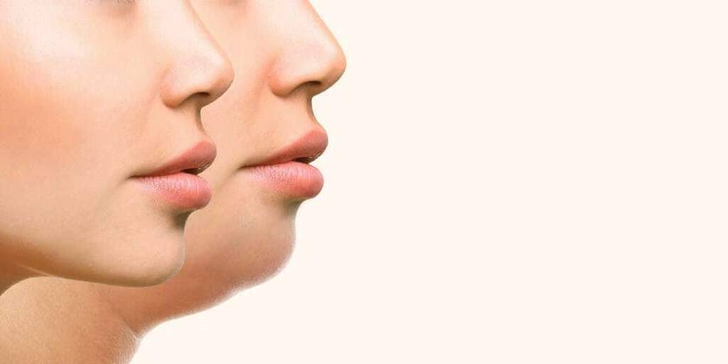 best workout for fat chin